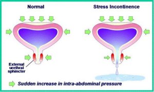 stress incontinence Australia-1