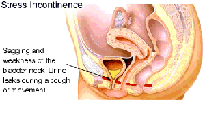 Stress Incontinence 